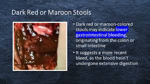 Image result for dark black stool human poop
