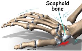 Image result for Scaphoid Fracture Signs