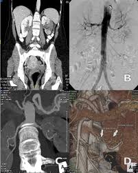 What Does It Mean If My Kub Ultrasound Said: 'Renal Parenchymal Disease,  Left. Nephrolithiasis, Left, Cannot Rule Out Beginning Staghorn Calculus  Formation. Mild Pelvocaliectasia, Left'? What'S Seriously Wrong With My  Left Kidney?