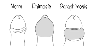 Image result for paraphimosis