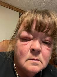 Hello, I am being treated for shingles, and while I was at the doctors  office, I mentioned being surprised that I would get shingles at age 36.  The nurse mentioned that while