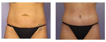 We did not find results for: 8 Things You Should Know About A Tummy Tuck From Someone Who Got One
