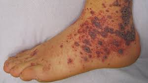 To improve incidence and survival rates, we need. Pre Leukemia Symptoms Causes And Treatments