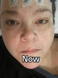 Does anyone here have a chronic illness/disability? If so, did you meet  your spouse/partner before or after becoming disabled?