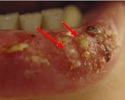 Image result for oral herpes symptoms roof of the mouth