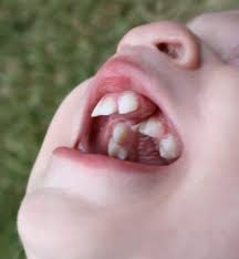 Cleft lip and cleft palate can be associated with a large number of craniofacial and genetic surgeries can include one or more of the following: Cleft Lip Cleft Palate Pediatric Dental Care Tips