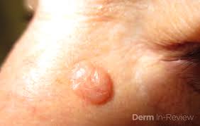 Metastatic skin lesions may originate from melanoma, breast, lung, colon, and various other types of cancer. Skin Cancer Next Steps In Dermatology