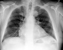 A large hamartoma of the spleen. Pulmonary Hamartoma Radiology Case Radiopaedia Org