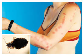 Image result for bedbugs bites