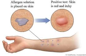 Image result for Allergy Screening