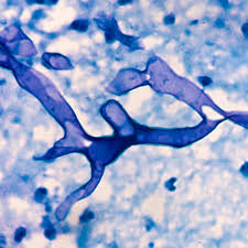 · invasora (mucormicosis rino orbital y cerebral que afecta a la nariz, ojos y cerebro). Que Es La Mucormicosis Hongo Negro Konsultasyon Net