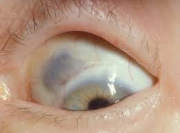 Image result for lesion sclera