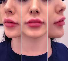How To Get Beautiful And Kissable Lips Like This Botox Lips Lip Injections Lip Fillers Juvederm
