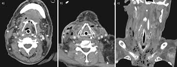 Check spelling or type a new query. Descending Necrotising Mediastinitis Two Case Reports And Review Of The Literature European Respiratory Society