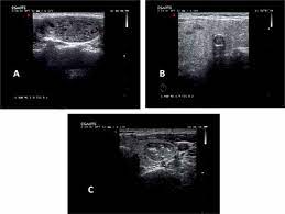 Nov 26, 2015 · introduction. Scielo Brasil Evaluation Of Cytopathological Findings In Thyroid Nodules With Macrocalcification Macrocalcification Is Not Innocent As It Seems Evaluation Of Cytopathological Findings In Thyroid Nodules With Macrocalcification Macrocalcification