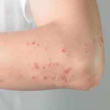 Which means that the cancer is confined to the top layer of skin, thus being highly curable. Bountiful Skin Rash Treatment Examination Skin Care Hadley