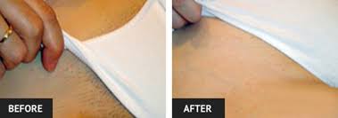 Laser hair removal is a procedure that permanently reduces the amount of unwanted body hair by killing the roots of the hair follicles in the targeted zone, whether face, body, or bikini area. Laser Hair Removal Before And After Pictures Laser Lipo Vein Center
