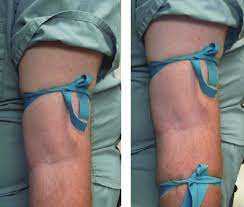 What are the steps in applying a tourniquet? Standard Tourniquet Pictured Left Double Tourniquet Pictured Right Download Scientific Diagram