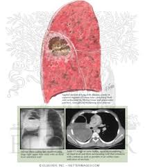 Image result for Lung Abscess