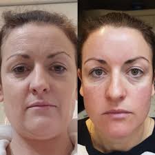 12 hours after our Ameson Micro needling! What I used: Mandelic Acid Peel  has a mild keratolytic effect, skin cell regeneration, hydration &  antimicrobial effect. Rejuvin vial for hydration, remodelling, tightening &