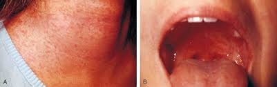 There is a large, partly denuded area of epithelium. Infectious Disease Obgyn Key