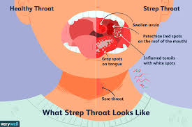 Image result for Strep throat infection roof of mouth