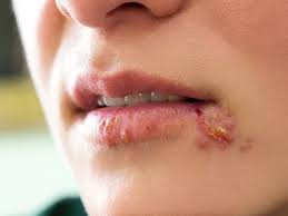 Spanning 26,000 acres of the ouachita mountains, hot springs village is the largest private, gated community in north america and is home to 12 lakes, nine professionally designed golf courses that are. Herpes Simplex Virus Symptoms Causes Types Natural Remedies For Relief Health Tips And News