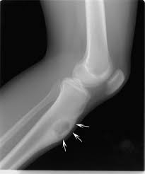You could have pain that travels along a nerve giving you pain in a different part of your body to where the tumour is. Noncancerous Bone Tumors Bone Joint And Muscle Disorders Merck Manuals Consumer Version