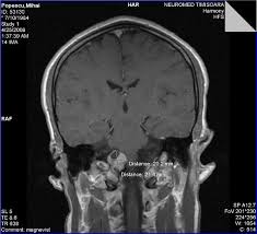 Boek nu een afspraak met dr patrick fransen (neurochirurg) telefoonnummer: Mihai Popescu Povestea Lui Dasanti S Weblog Viata Sentimente Informatie