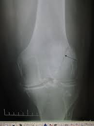 Image result for Knee XRay