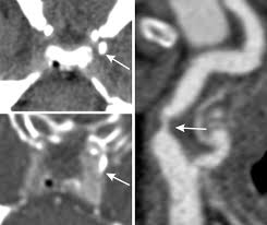 In carotid angioplasty, a long, hollow tube (catheter) is threaded through the arteries to the narrowed carotid artery in the neck. Calcium At The Carotid Siphon As An Indicator Of Internal Carotid Artery Stenosis Springerlink