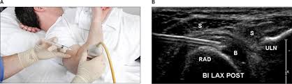 Image result for Biceps Tendon Injection