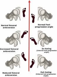 Image result for Foot Progression Angle