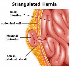 La hernie inguinale simple est la plus fréquente des hernies et survient principalement dans la deuxième partie de la vie. Ce Este Si De Ce Apare Hernia Inghinala Cauze Simptome Metode De Tratament Si Prevenire