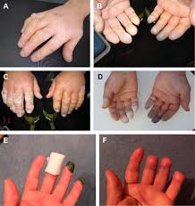 Frostbite stages and symptoms include burning, numbness, tingling, and itching of the skin. Frostbite Emergency Medicine Clinics
