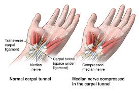 Carpal Tunnel Syndrome | Johns Hopkins Medicine