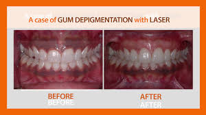 Check spelling or type a new query. Wisdom Teeth Removal Cost In India Teethwalls