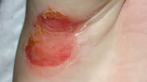 Intertrigo (intertriginous dermatitis) is an inflammatory condition of skin folds, induced or aggravated by heat, moisture, maceration, friction. Intertrigo Treatment Signs Pictures And Prevention