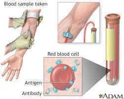 An antibody titer is a type of blood test that determines the presence and level (titer) of antibodies in the blood. Antibody Titer Information Mount Sinai New York