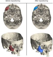 Check spelling or type a new query. Zygomatico Orbital Fracture Dislocation In Surgical Treatment Novel 3 Dimensional Software Automated Analysis Journal Of Oral And Maxillofacial Surgery