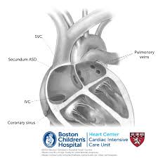 Image result for Atrial Septal Defect