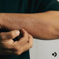 Image result for Hives