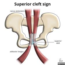 Image result for Pubic Apophysitis