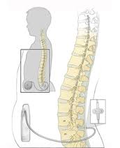 Image result for Intrathecal Pump