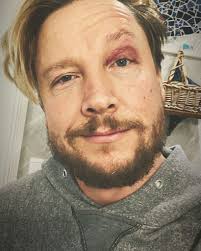 Samu haber wurde am 02. Autsch Woher Hat Sanger Samu Haber Bloss Dieses Veilchen Promiflash De