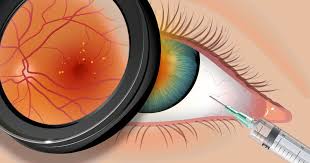 Avastin is administered by an injection into your eye as needed at regular intervals (about every four to six weeks); Side Effects Of Avastin Injections In The Eye