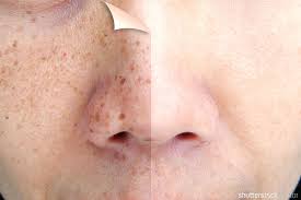 Image result for Freckled skin