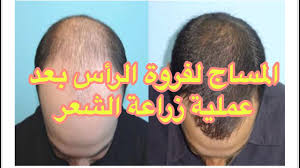 مساج الشعر بعد العملية تدليك فروة الرأس بعد عملية زراعة الشعر Youtube
