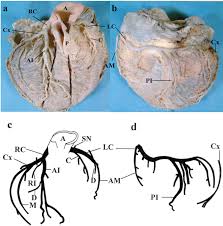 Lelft emfatinmdiaaginonal artery diagonal artery. Myocardial Bridge In Dextrocardia With Situs Inversus