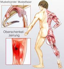 Eine zerrung des quadrizeps kann nach intensiver, starker schmerzen am äußeren oberschenkel. Muskelzerrung Ursache Beschwerden Und Behandlung